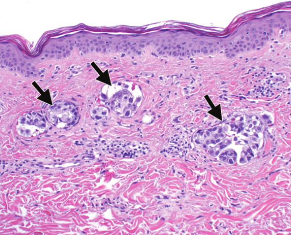 Thymic Cancer (Thymoma and Thymic Carcinoma)